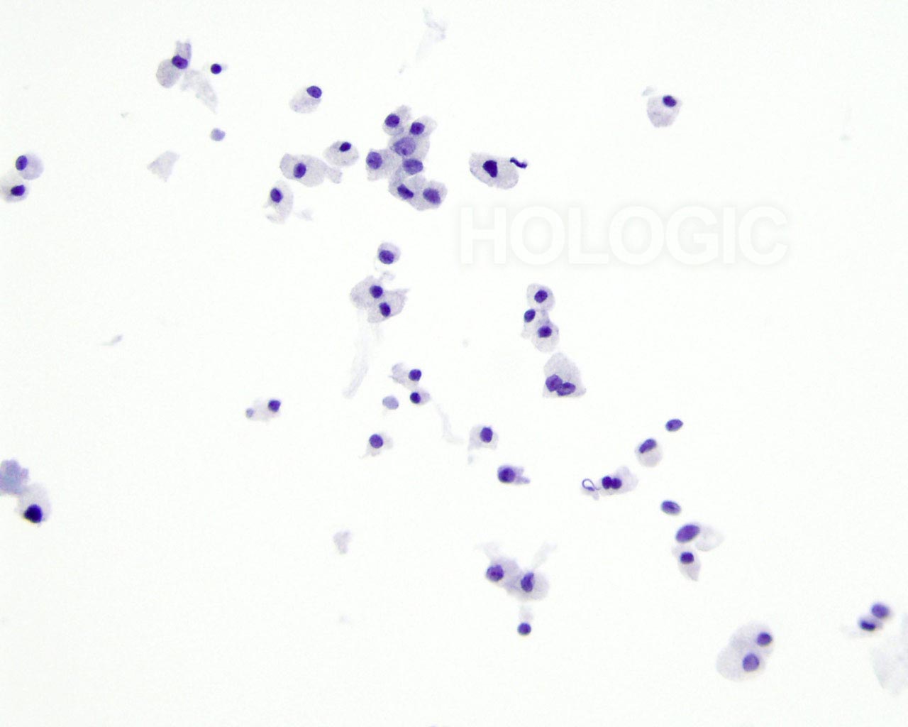 hurthle cell neoplasm cytology